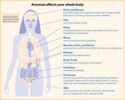 anorexia eating disorder