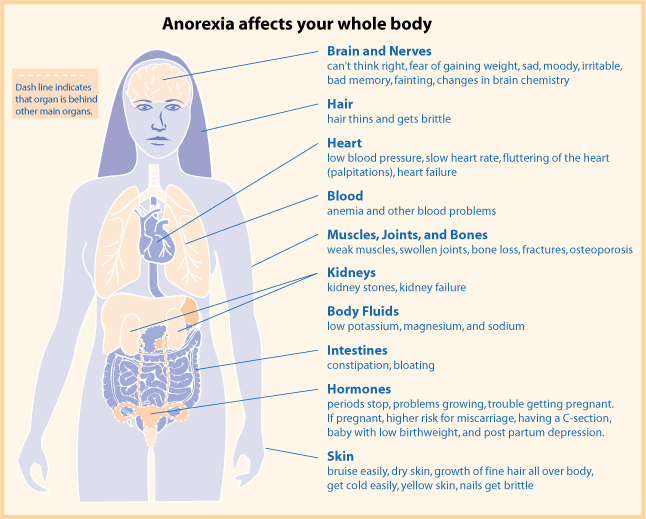 anorexia eating disorder